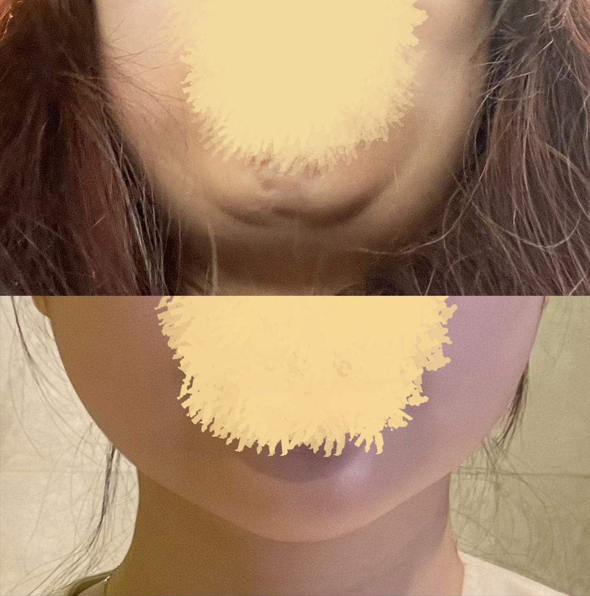 수술전후정면.jpg