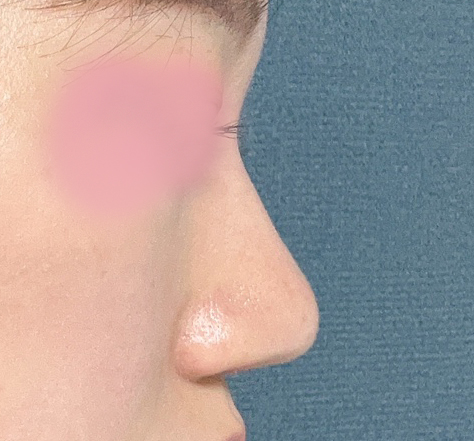 바이브에서 무보형물코성형한 후기올려욥