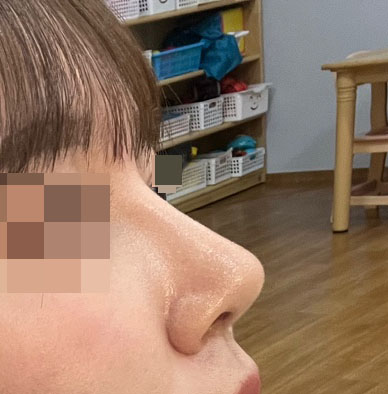 코, 얼굴지방흡입 7개월차 된 후기!!