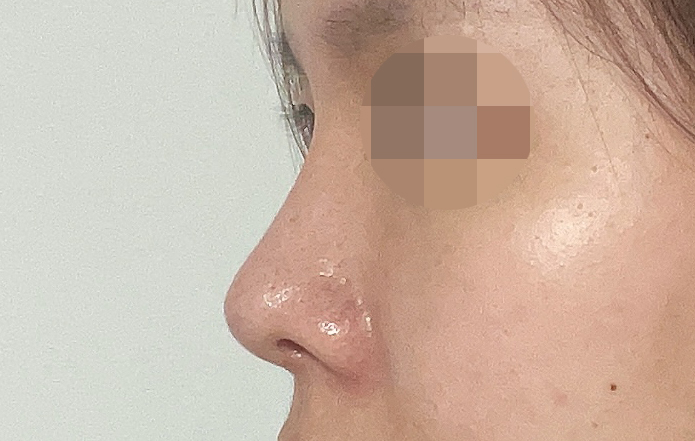 복코+매부리코수술한지 5개월지났어요:)