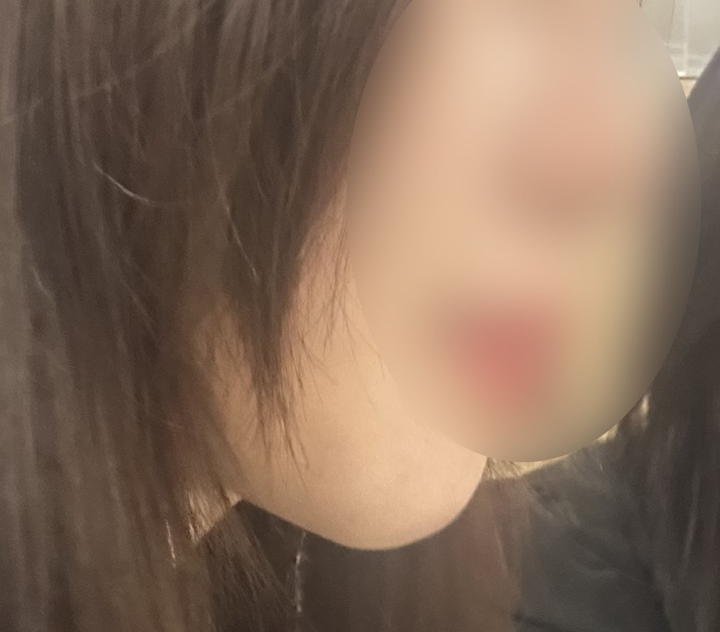 얼굴지방흡입 정말 잘한 수술같아요 ㅠㅠ!!