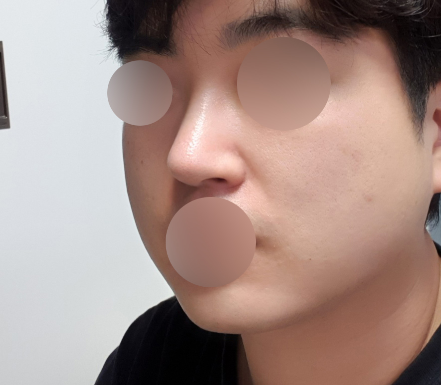 30대남자코성형(기능코+미용코), 지방흡입 6개월차
