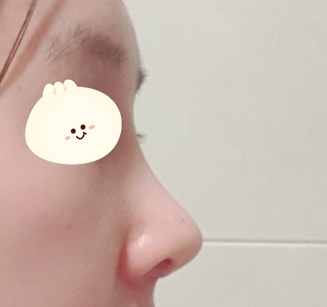 처진 매부리코 넘 잘됐어요 ㅠㅠ