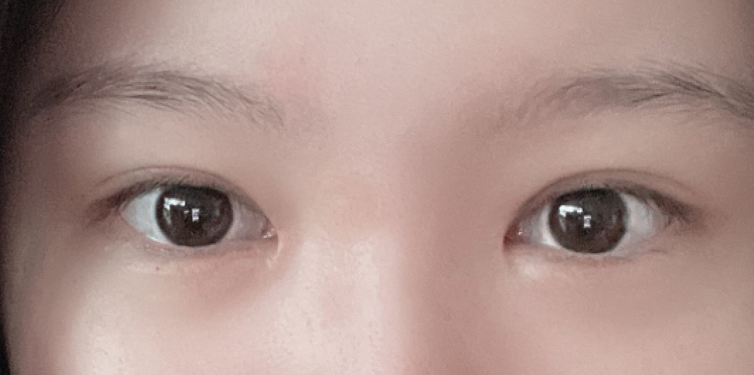 쌍수한지 벌써 6개월이네요