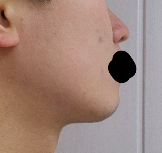 남자 얼굴지방흡입 3달차입니다.