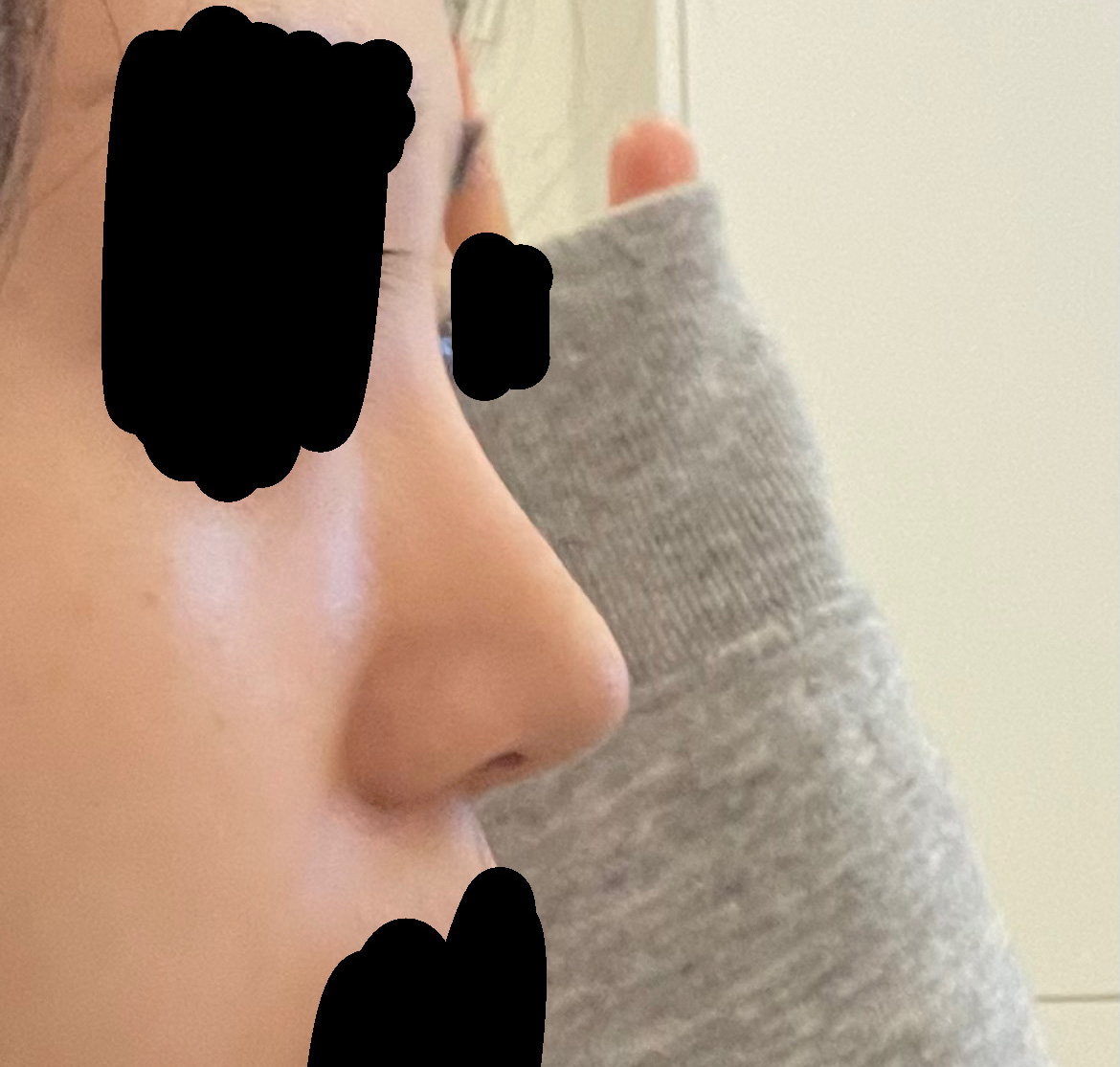 미용, 기능 모두 만족스러운 수술ㅎㅎ