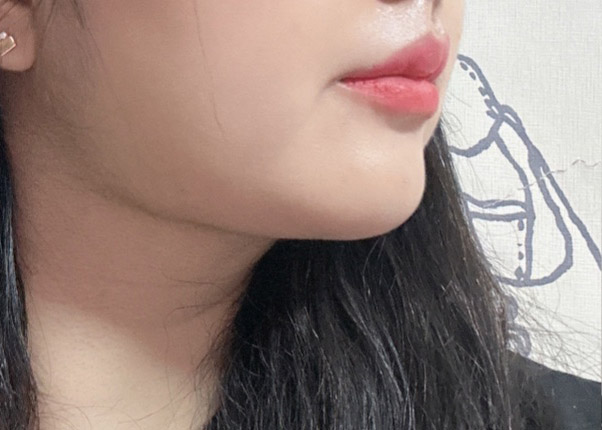 투턱이 사라졌어요ㅎㅎ