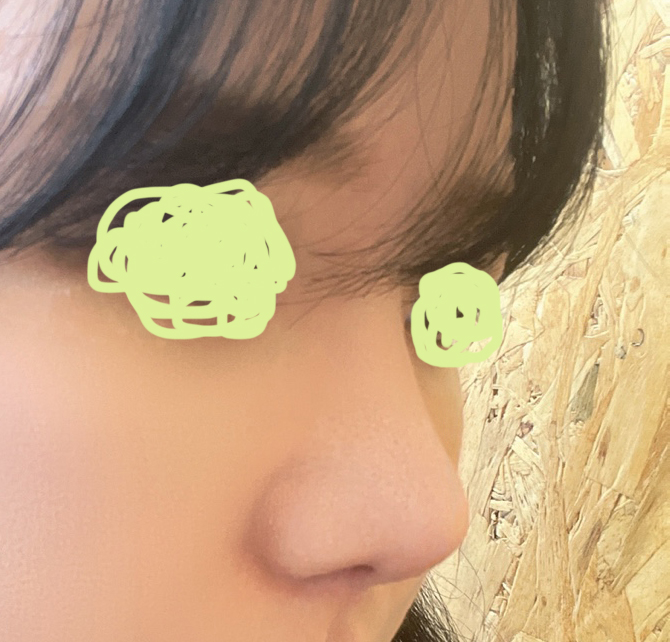 눈재수술+코성형 3주차!!! ㅎㅎ