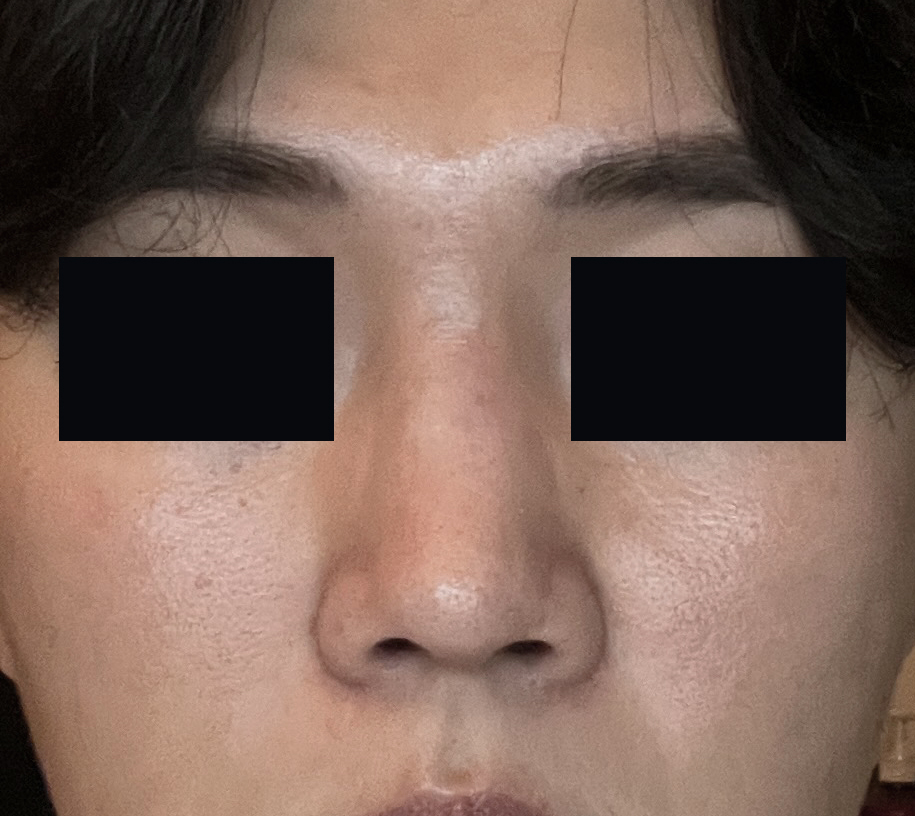 콧구멍비대칭, 비공내리기로 교정한 후기