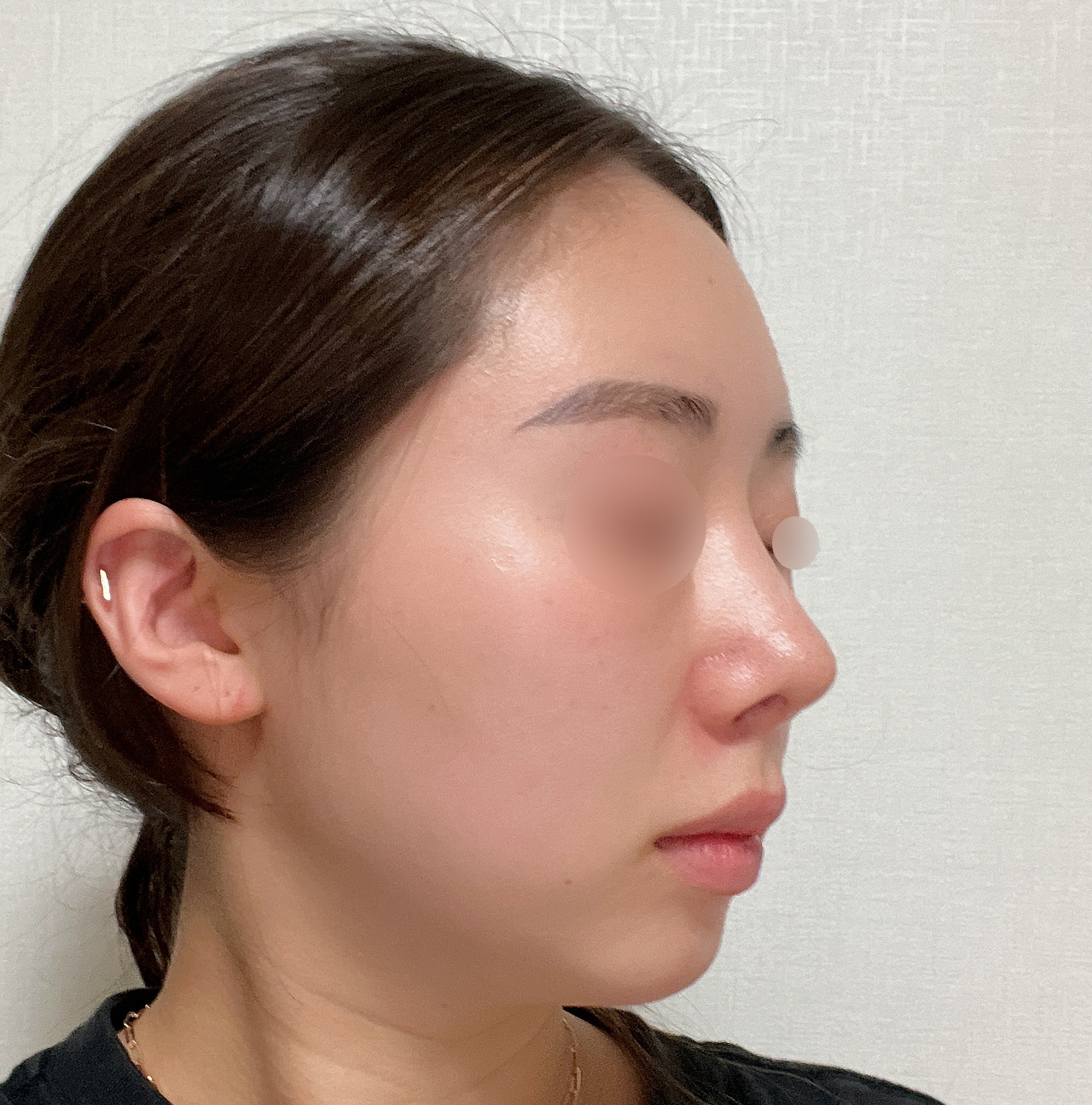 원장님의 꼼꼼한 수술 덕분에 예뻐졌어요