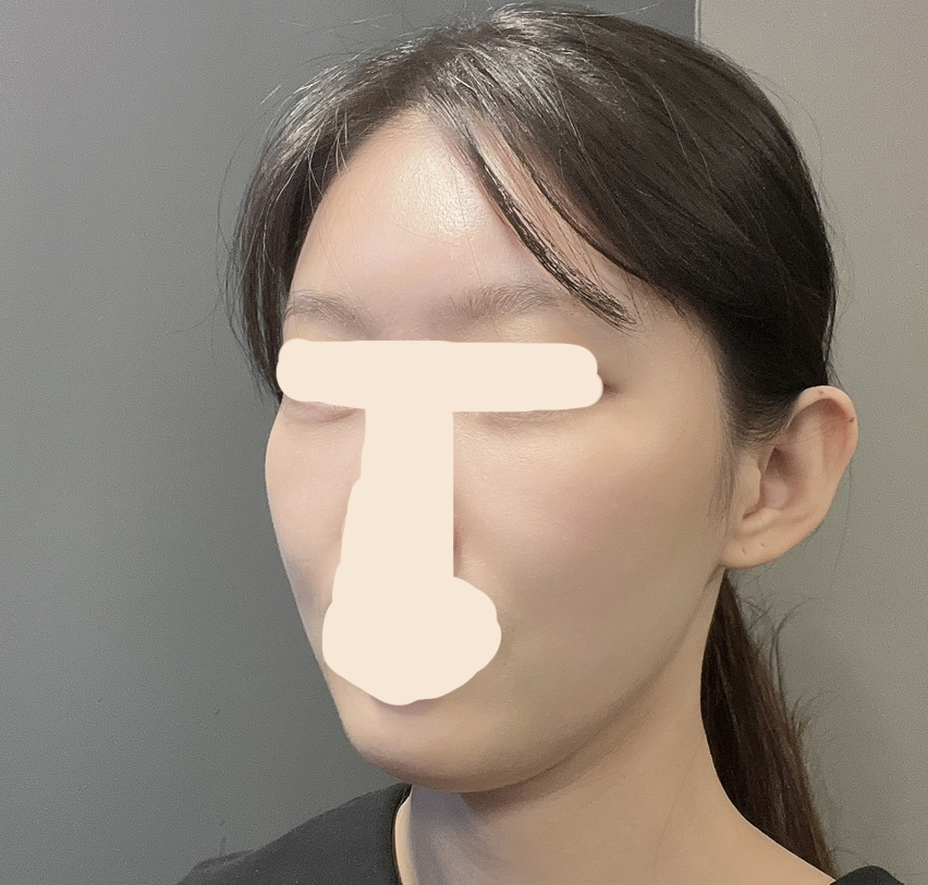 눈밑지방재배치+풀페지방이식 후기!