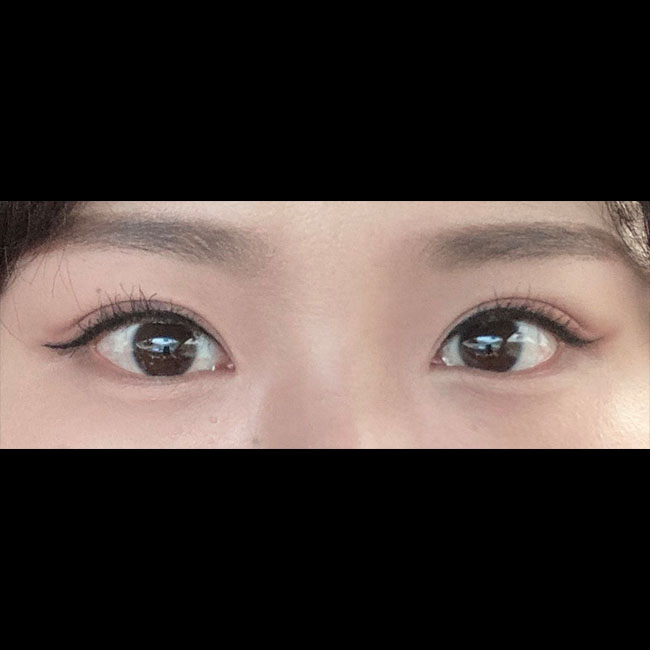 17년도에 눈성형하고 풀려서 재수술했어용