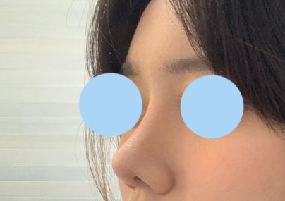 코성형 성공적!!