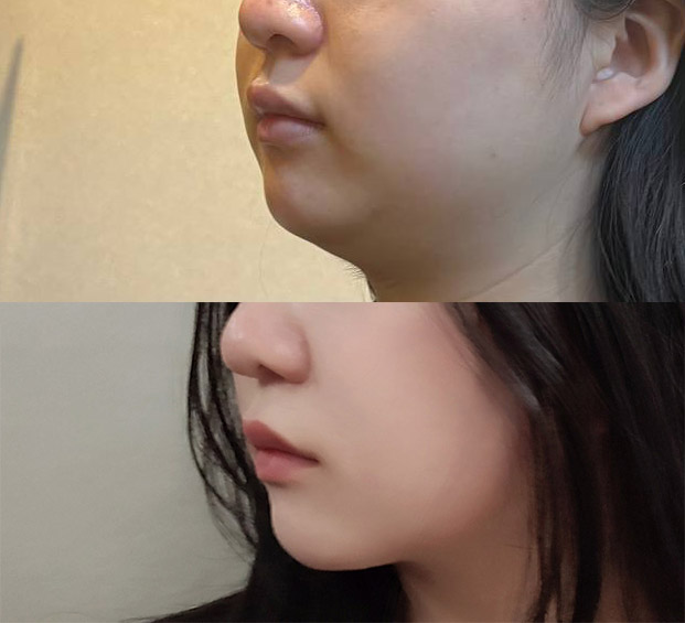 얼굴지방흡입 너무너무만족쓰 ㅠㅠ