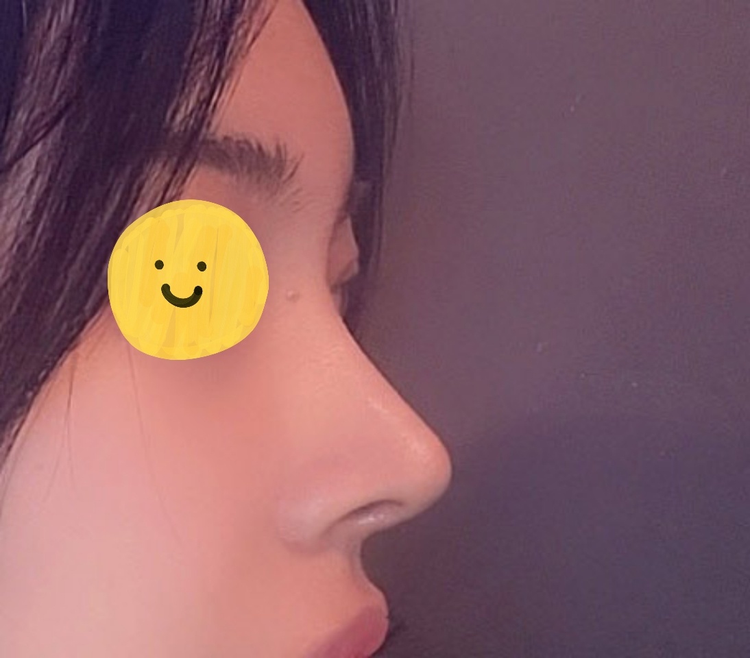 눈,코 3개월차~~~!