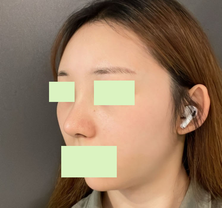 코&지방이식 1달 넘은 후기입니닷~~