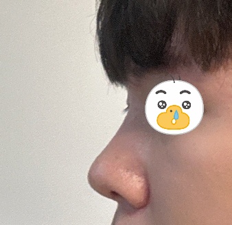 쓰다보니 길어졌네요 ㅎㅎ남자코성형후기!