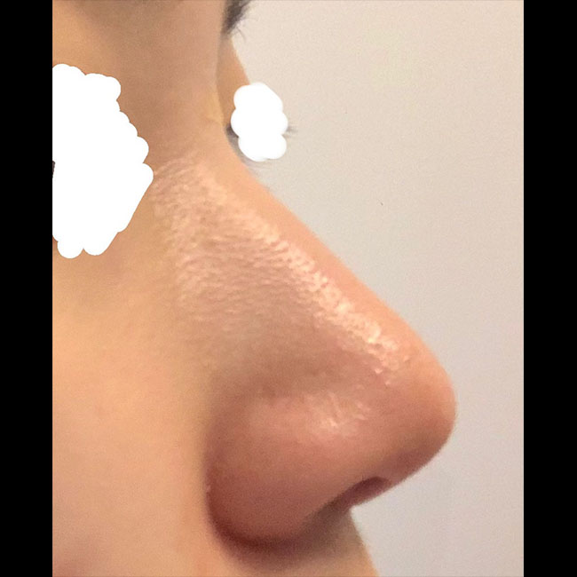 무보형물 코수술 4개월됐네욤