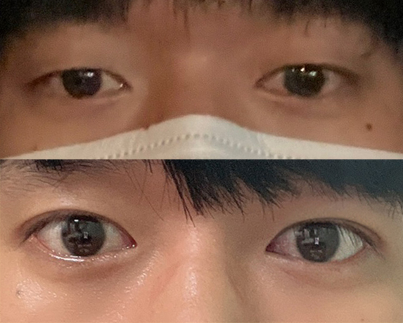 눈매교정 정말 자연스러워요