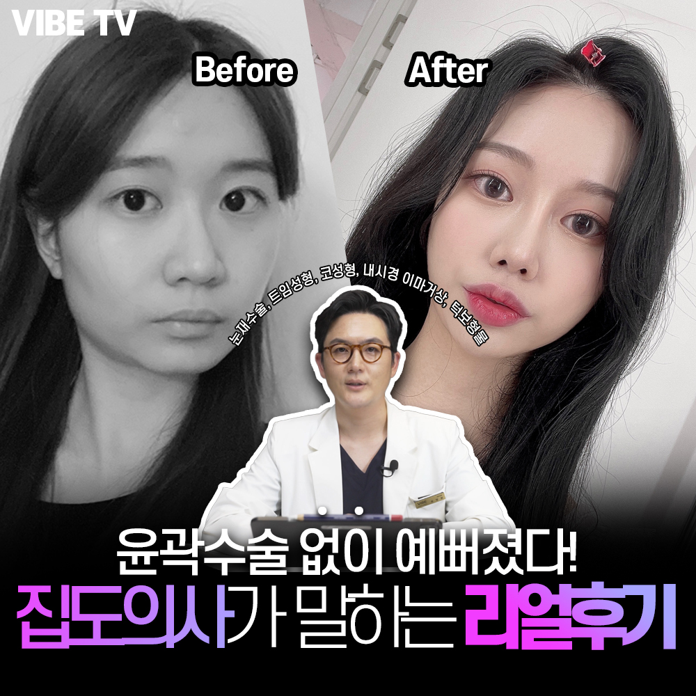반응이 가장 뜨거운 바이브 실제수술사례자 성형리뷰!