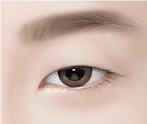 비절개 눈매교정 Step 01