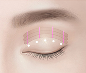 비절개 눈매교정 Step 02