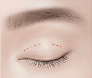 절개 눈매교정 Step 01