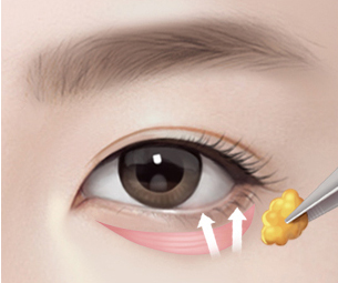 하안검성형술 Step 02