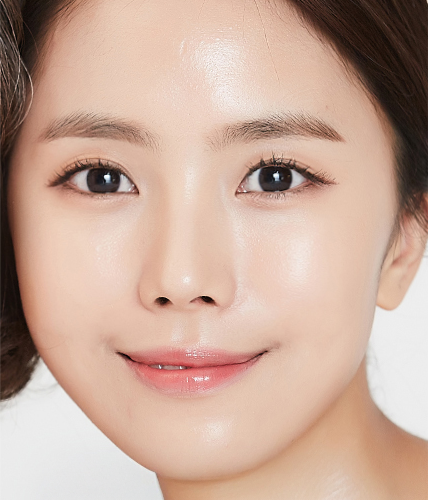 눈밑지방재배치