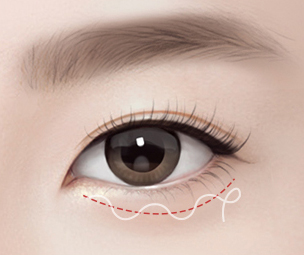 하안검성형술 Step 03