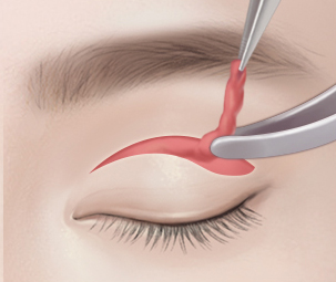 상안검성형술 Step 02