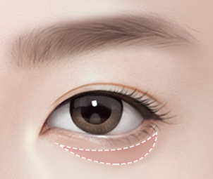 하안검성형술 Step 01