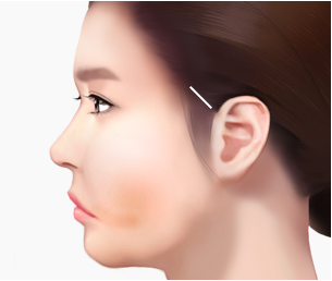 미니리프팅 Step 01