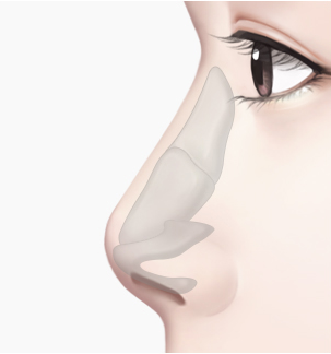 들창코 수술 Step 01